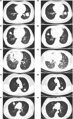Efficacy of Combination Chemo-Immunotherapy as a First-Line Treatment for Advanced Non-Small-Cell Lung Cancer Patients With HER2 Alterations: A Case Series